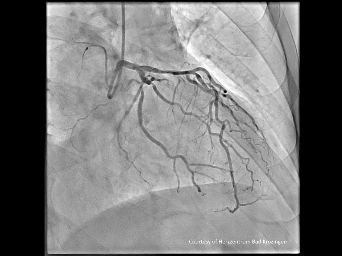 Angiography