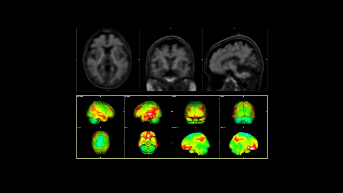 A typical amyloid PET scan of a patient with Alzheimer’s disease: The red areas are the affected regions in the brain.