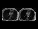 Faster MRI scans with Compressed Sensing from Siemens Healthineers