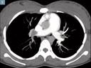 CT image shows bilateral pulmonary embolism in pregnant woman.