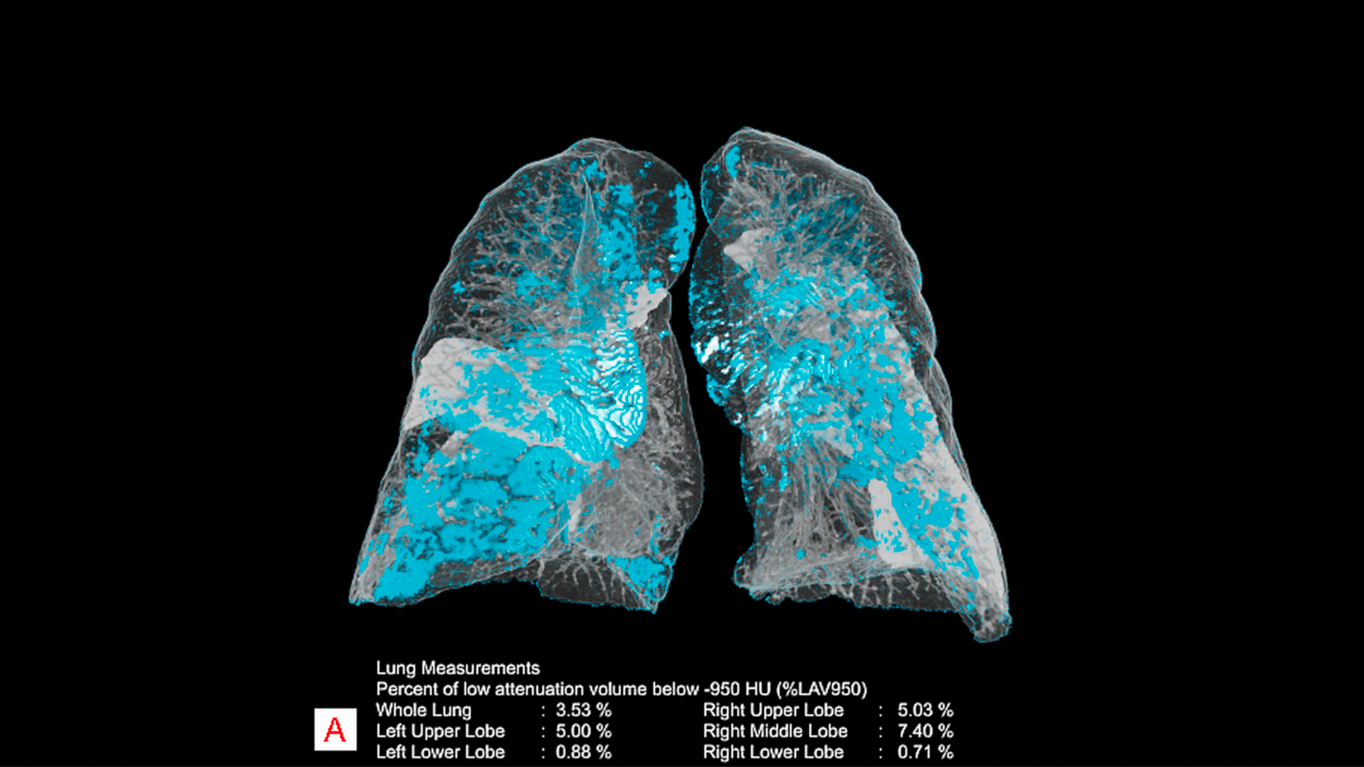 Siemens Healthineers further expanding AI portfolio in the field of ...