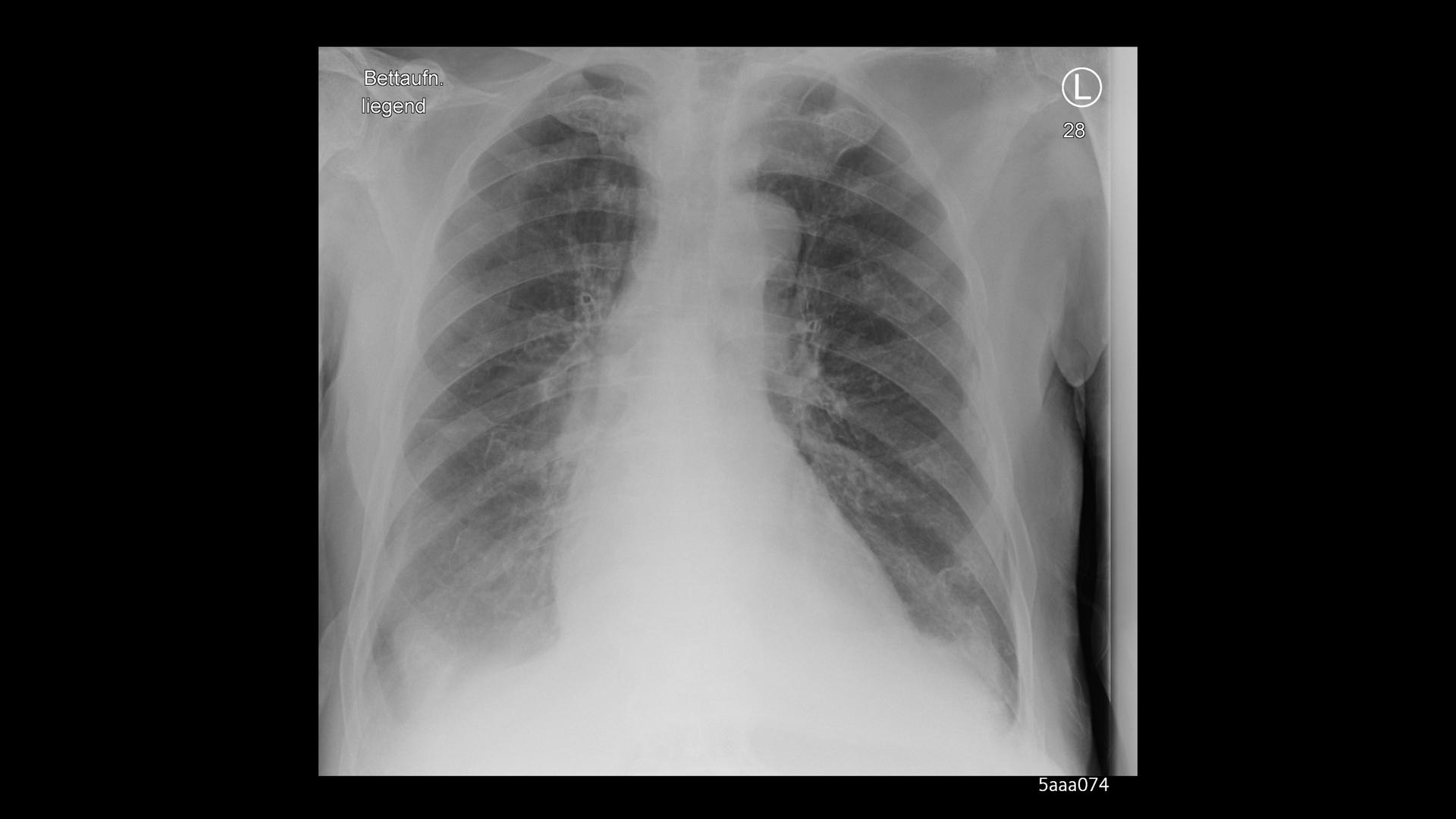 Xray imaging for COVID19 patients