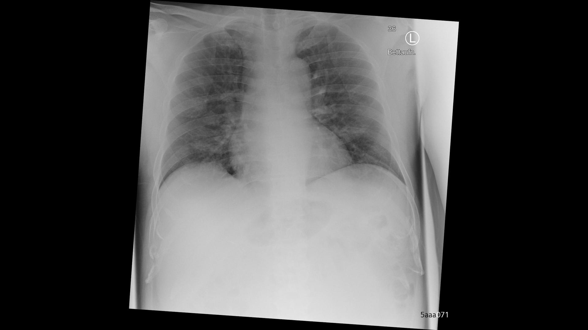 Xray imaging for COVID19 patients