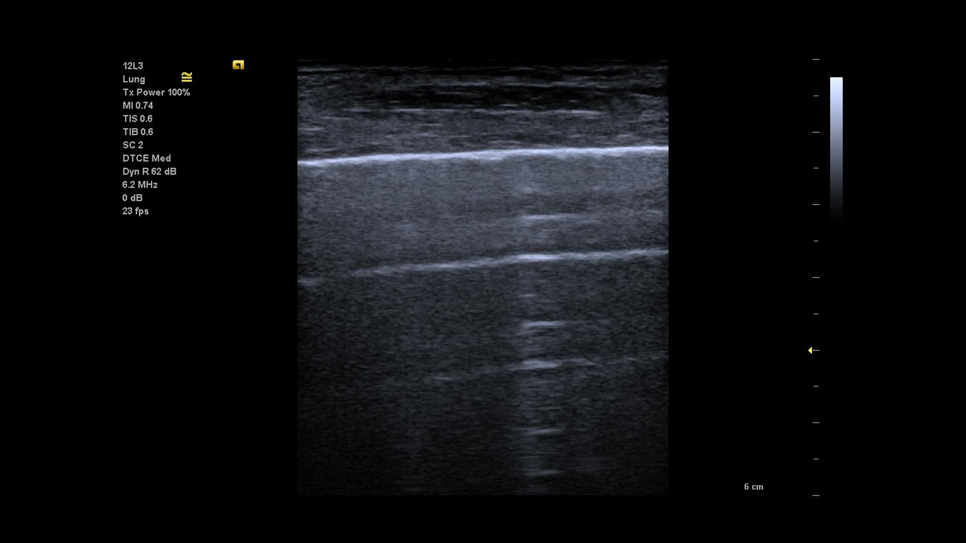 Sonographie bei COVID-19-Patienten