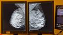 Tomosynthesis evaluation is also facilitated with the AI software.