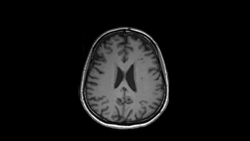 Magnetic resonance imaging in multiple sclerosis