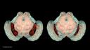 Computer illustration showing healthy substantia nigra and degenerated substantia nigra in the human brain.