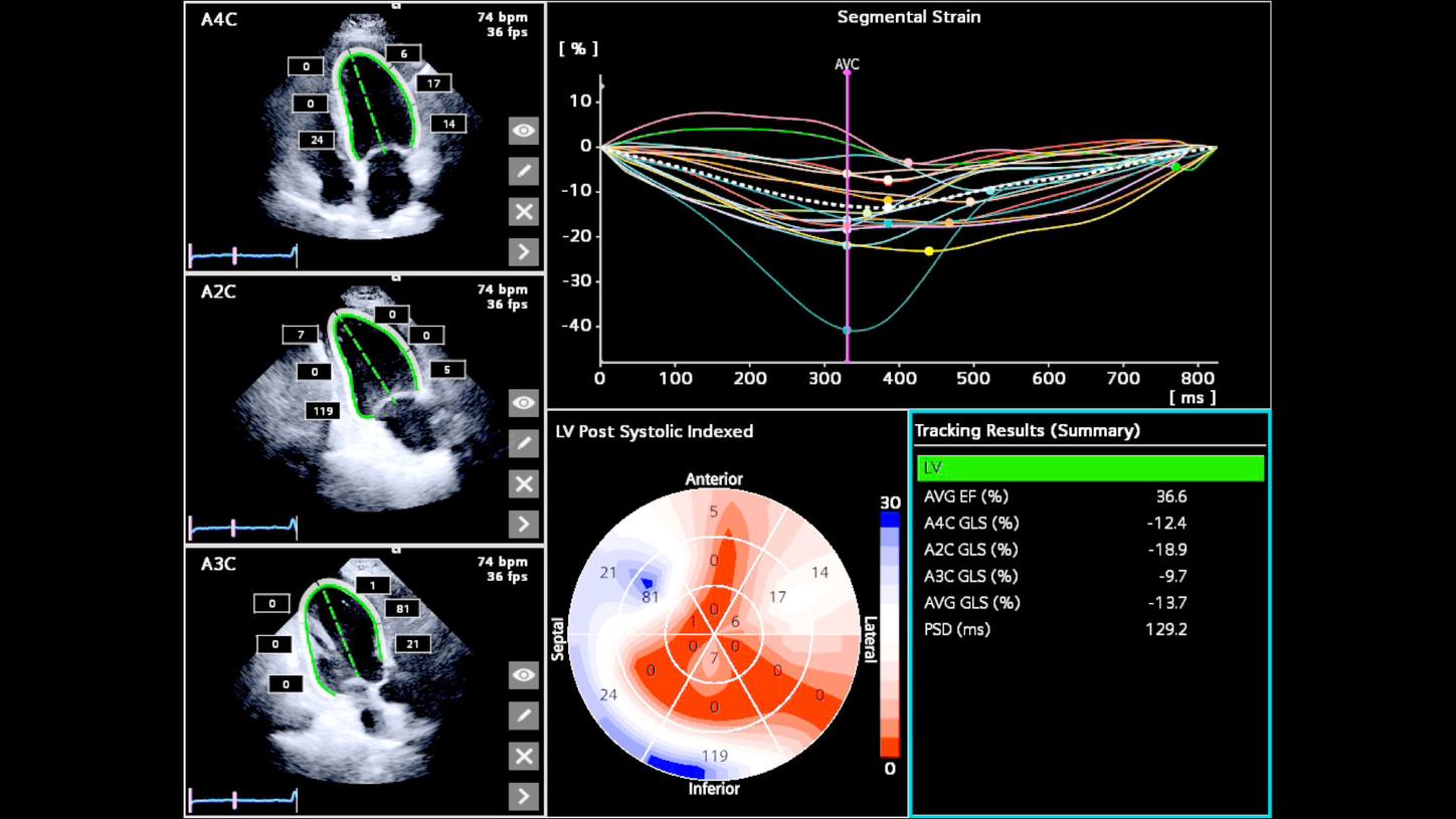 Abnormal strain pattern with ischemic cardiomyopathy with GLS -13 percent.
