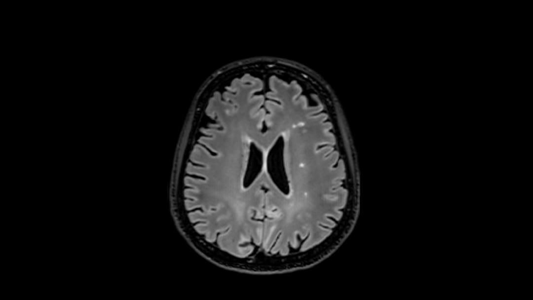 MRI image of MS lesions in the brain