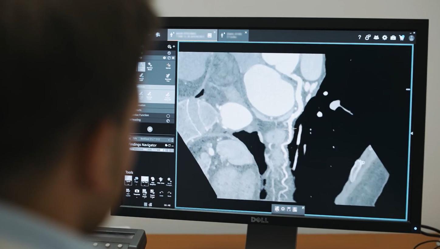 Siemens Healthineers announces Syngo.CT Coronary Cockpit, a new software solution within the Syngo.via platform designed to support the management of coronary artery disease.