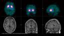 A normal SPECT DaT image (top) with the corresponding MR image (bottom).