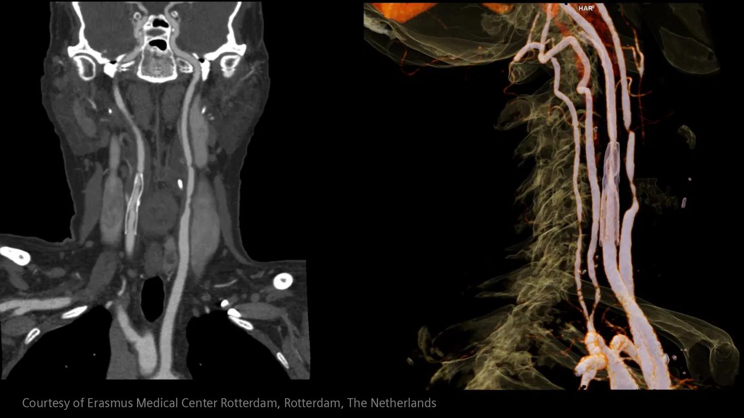 Large artery atherosclerosis