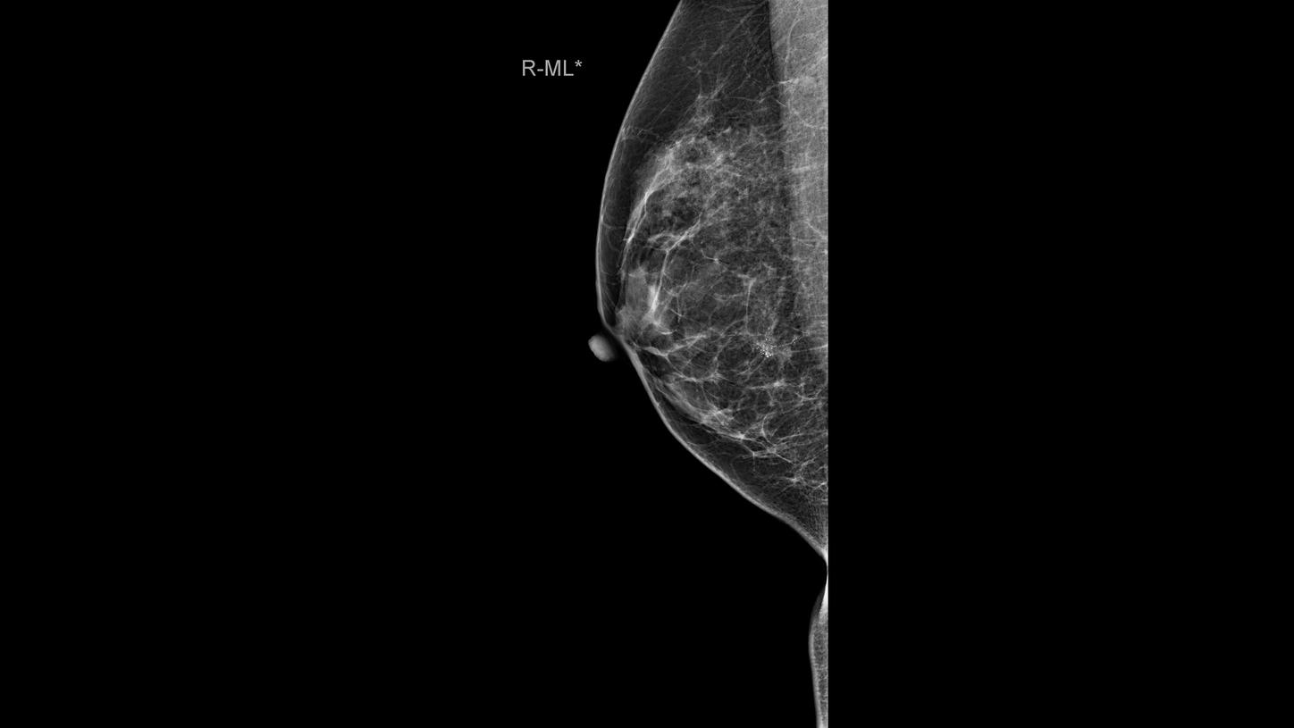 A mammogram shows calcifications, which proves to be a malignant tumor in biopsy.