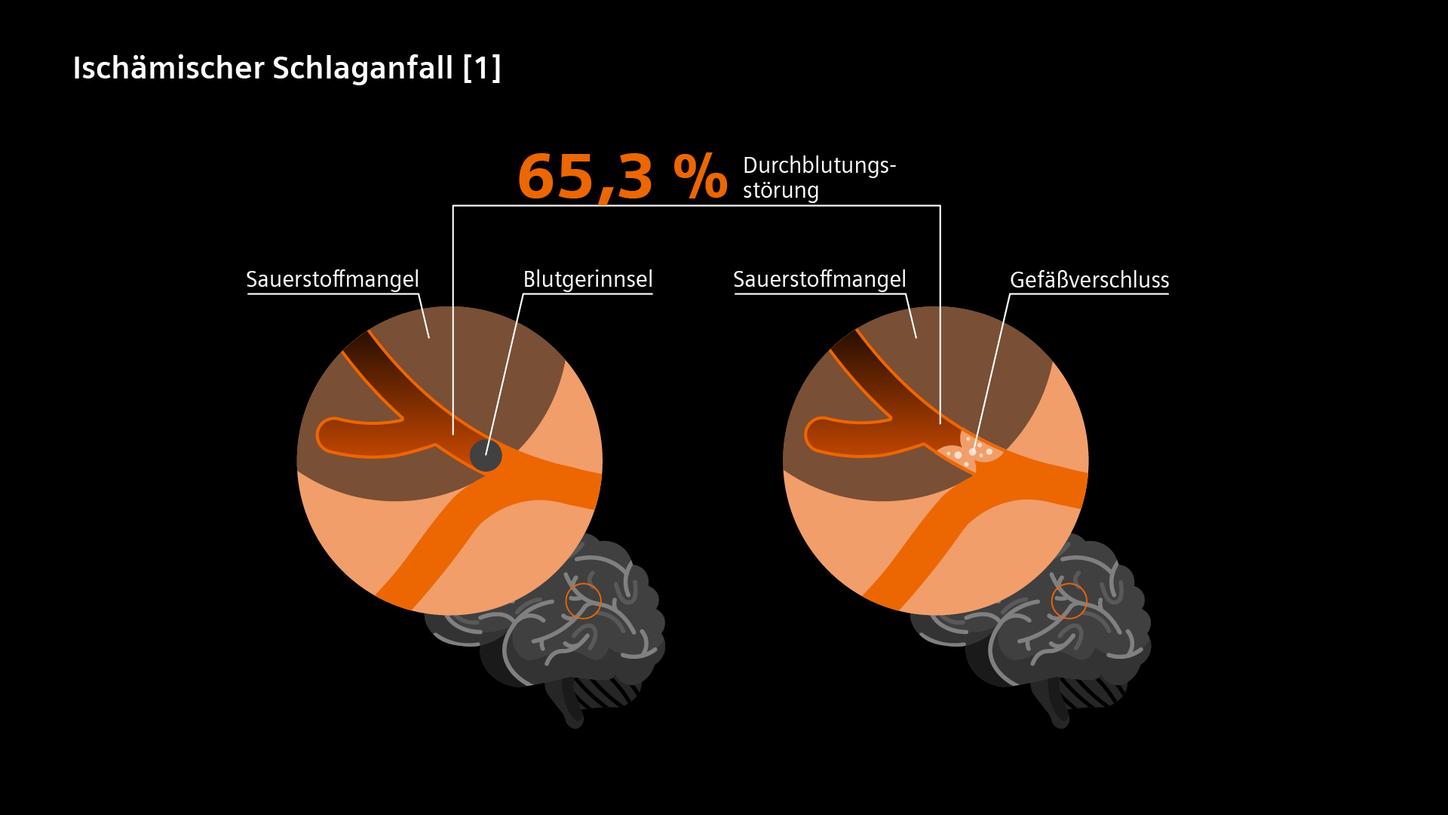 Ischaemischer Schlaganfall