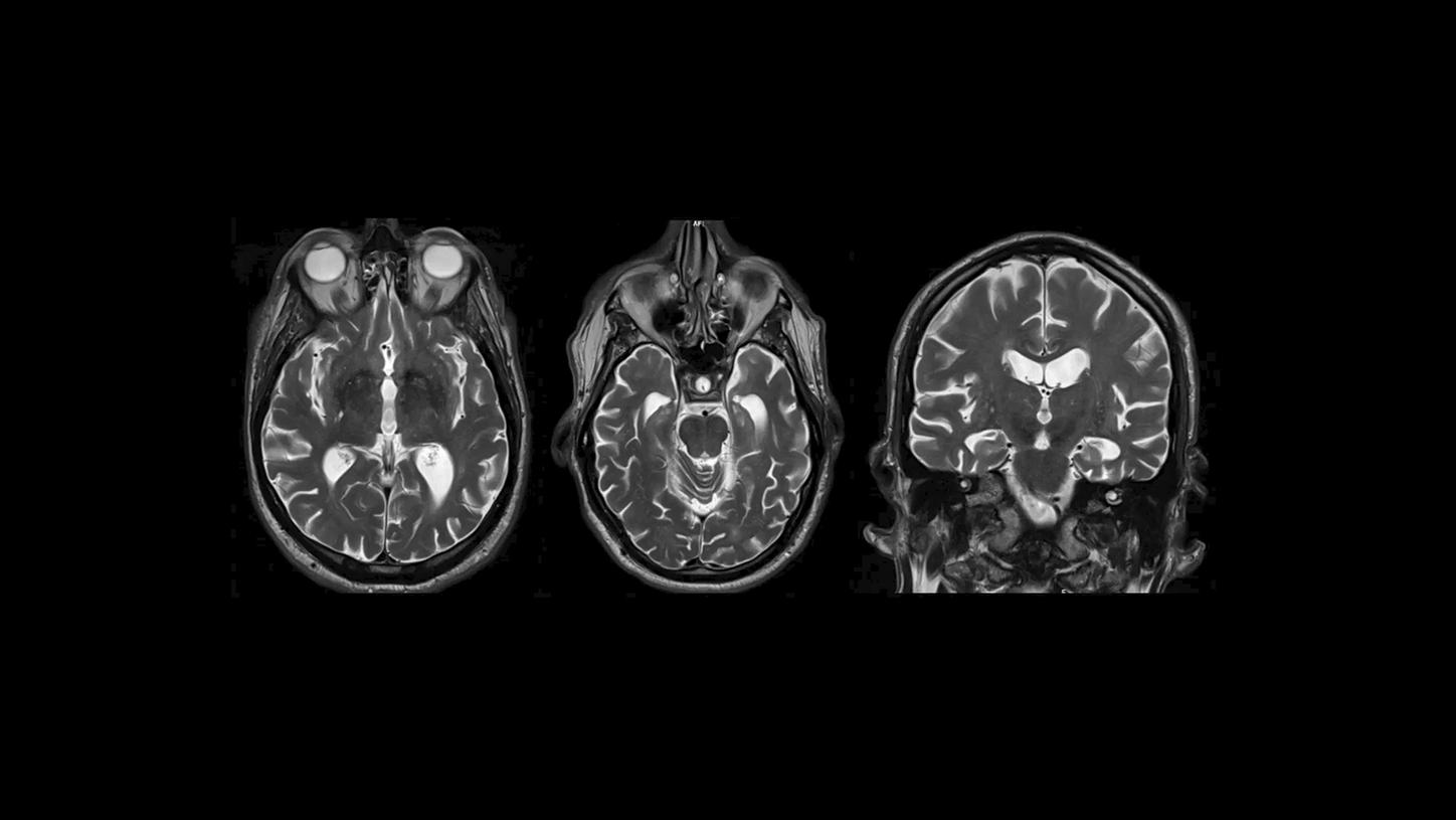 In der T2-MR-Bildgebung erscheinen Wasser und Liquor aufgrund ihrer hohen Signalintensität als helle Bereiche.