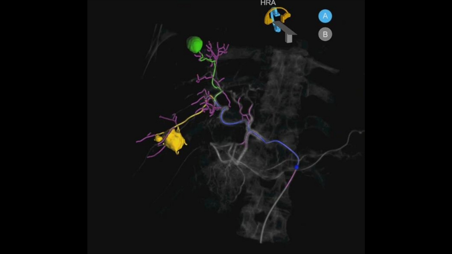 AI-powered MyEmbolization Guide clearly shows the targeted tumor and differentiates feeder from non-feeder vessels to facilitate finding the optimal treatment position. For liver and prostate workflows, it offers automatic length adaptation for non feeder vessels – shown here – and helps reduce information overload for the user, for example when overlaying planning data on live fluoroscopy during guidewire navigation.