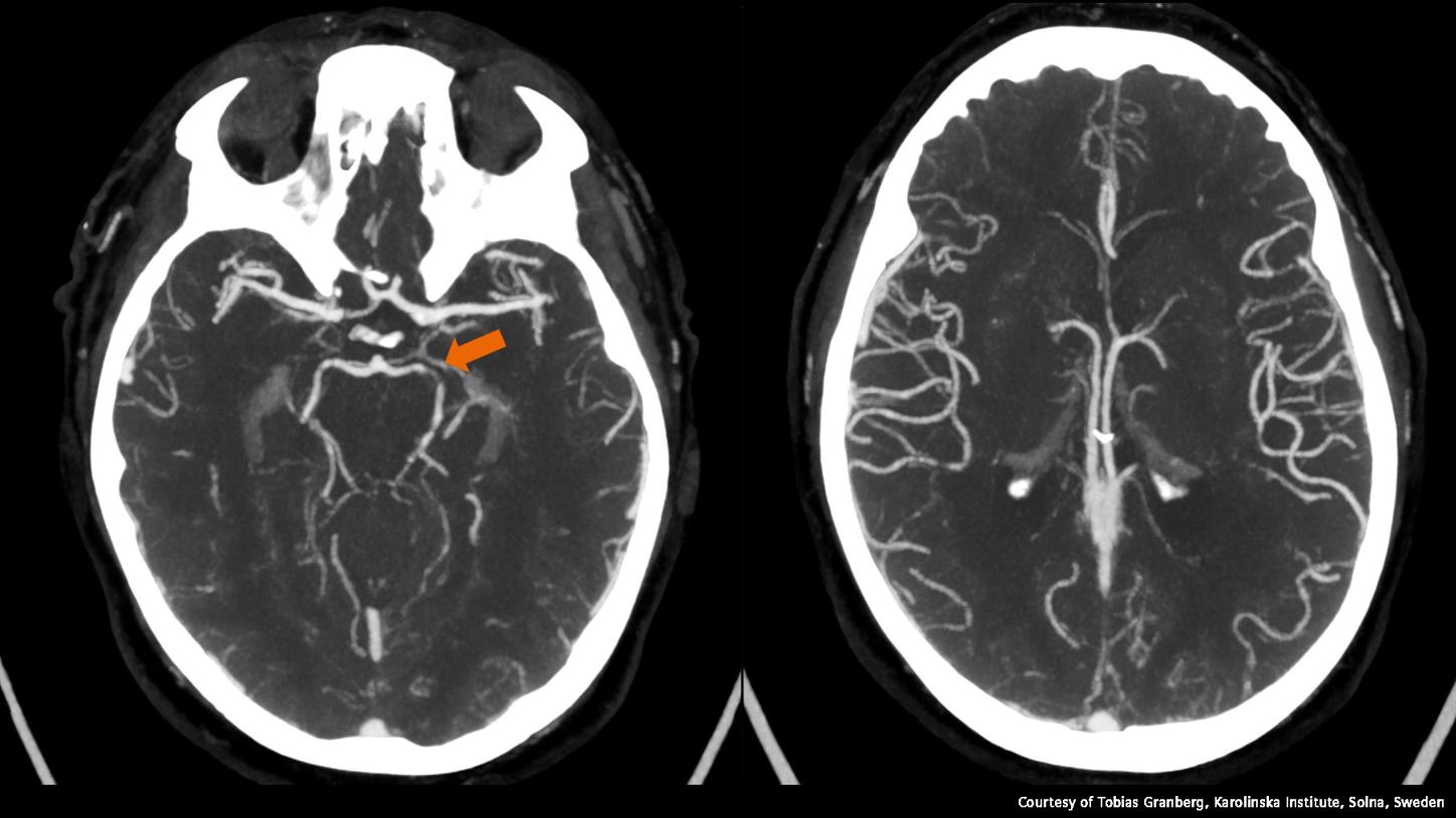 CT-Angiographie der Hals und Hirngefäße, aufgenommen mit photonenzählender CT