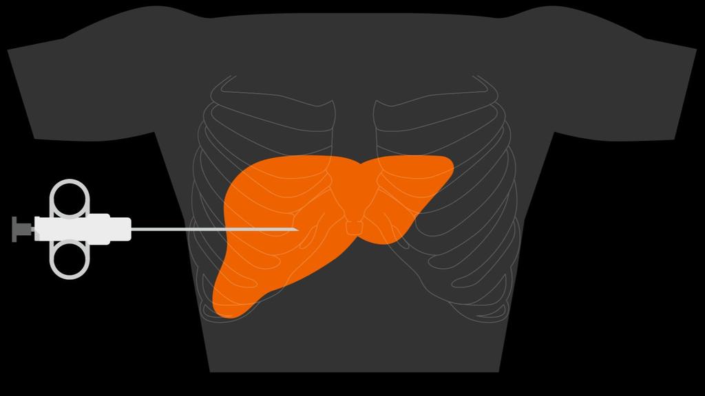 Liver Cancer From diagnosis to personalized treatment