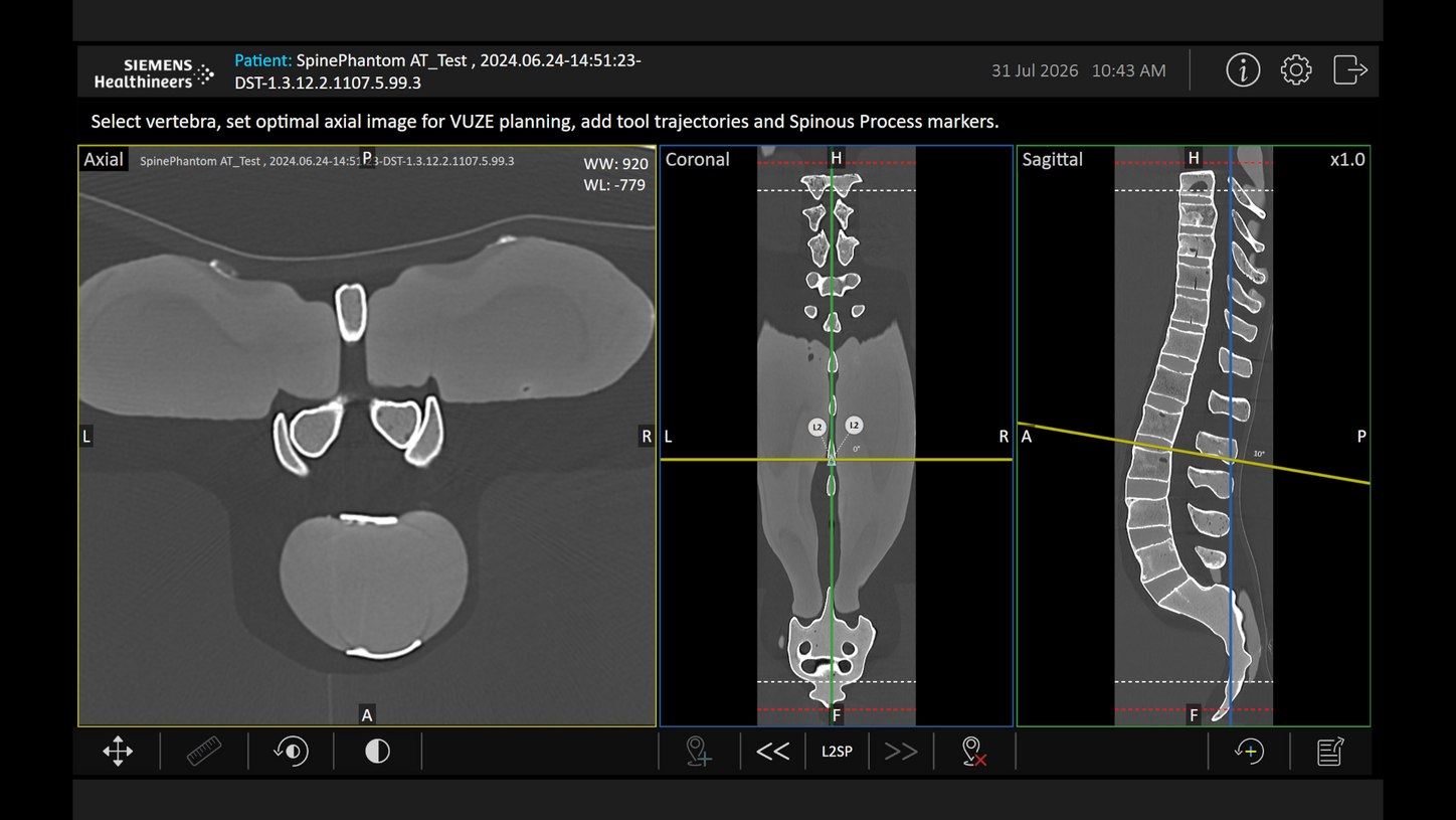 The Vuze2 guidance software for spinal surgery by Siemens Healthineers supports K-wire placement for pedicle screws by fusing preoperative Computed Tomography (CT) or intraoperative cone-beam CT (CBCT) images with intraoperative X-ray images of the patient without relying on external tracking hardware.