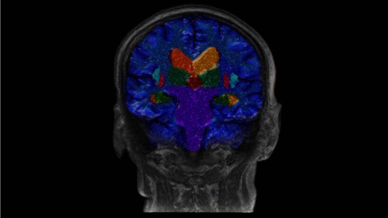 Segmentierung wichtiger Hirnstrukturen in der MRT bei einem älteren Patienten mit Symptomen einer Alzheimer Erkrankung. Quelle: Mit freundlicher Genehmigung des Universitätsspital Lausanne, Schweiz.