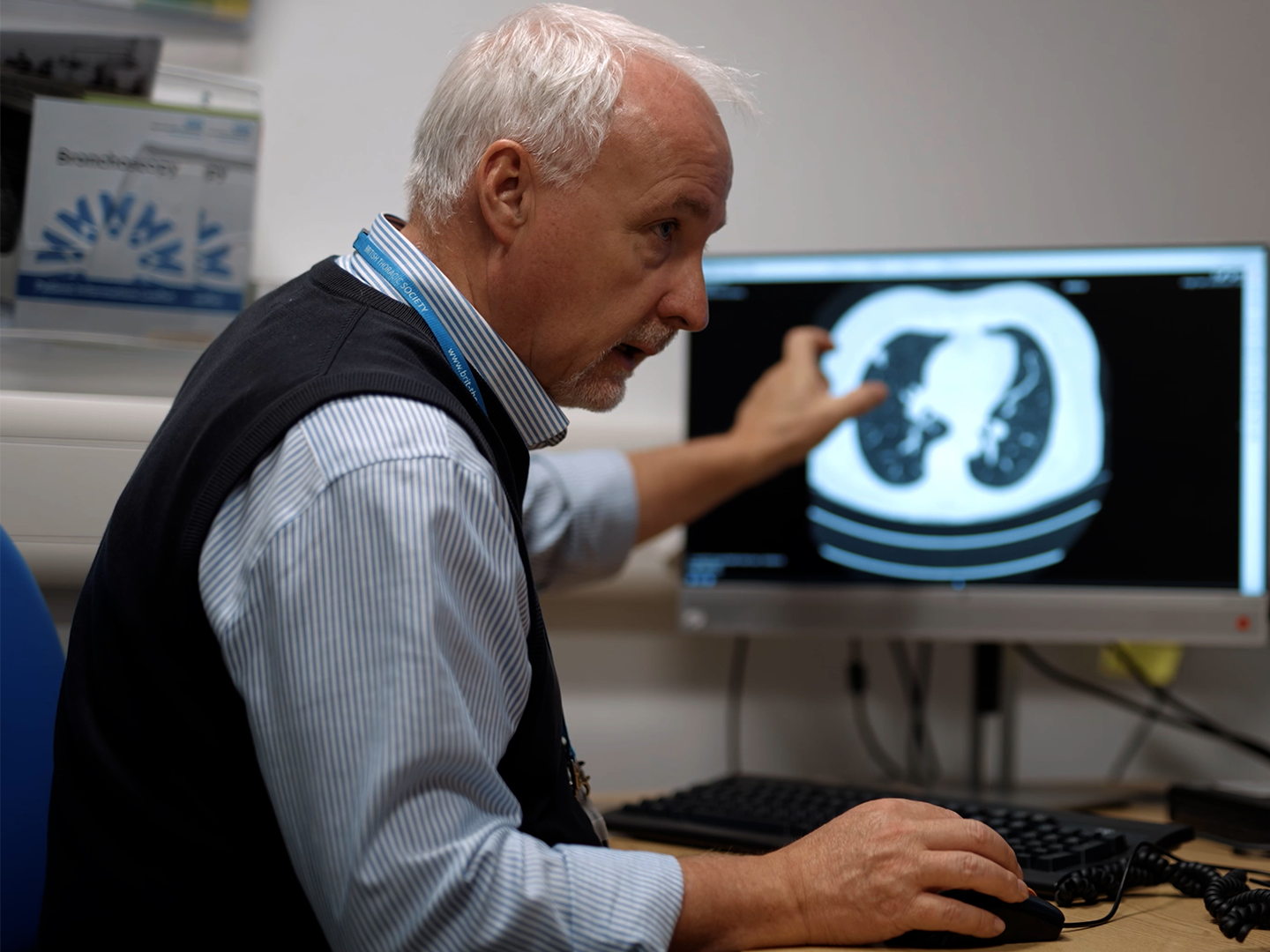 Lungcancer detection