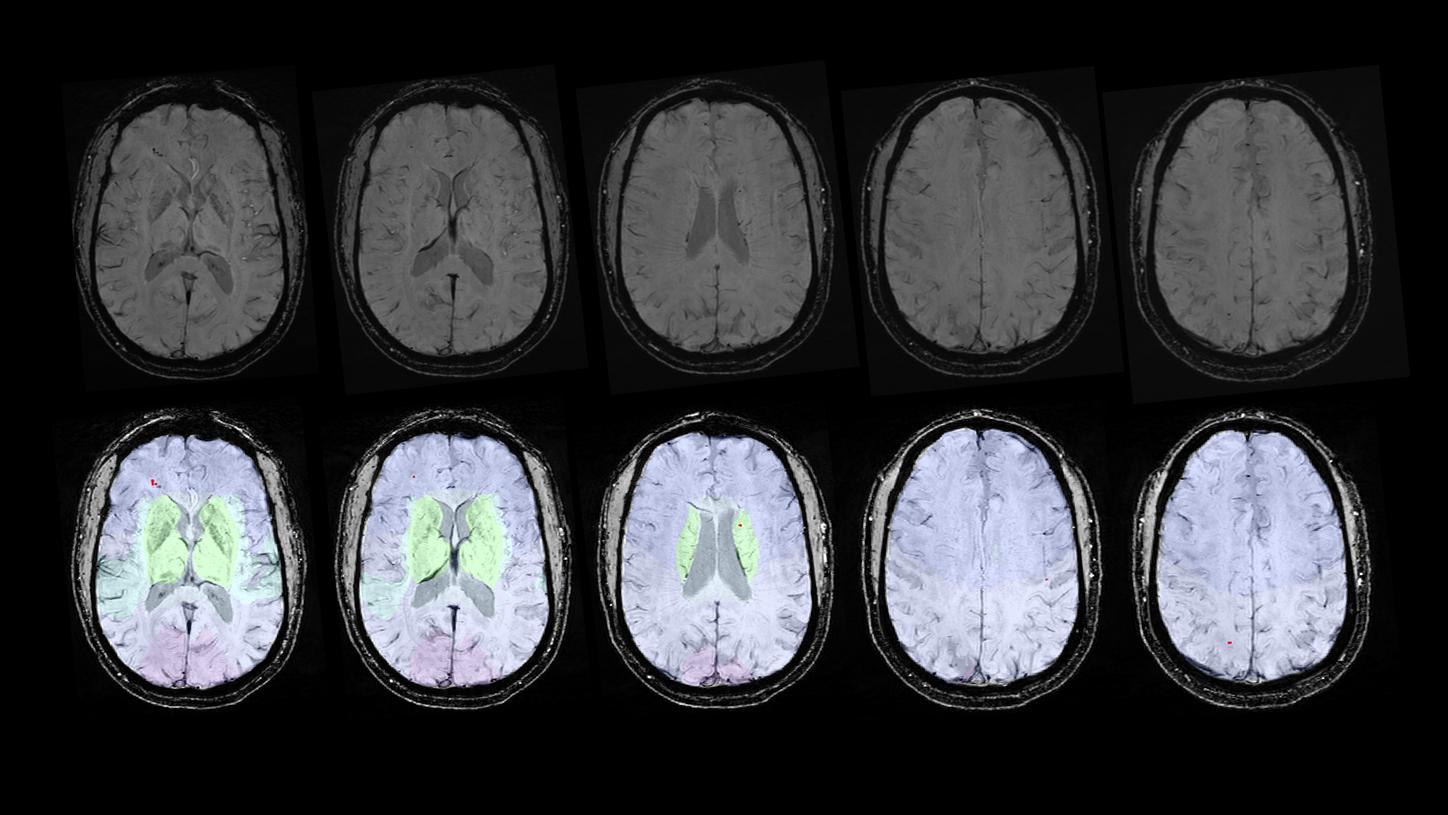 Identifying cerebral microbleeds with the help of AI (prototype)
