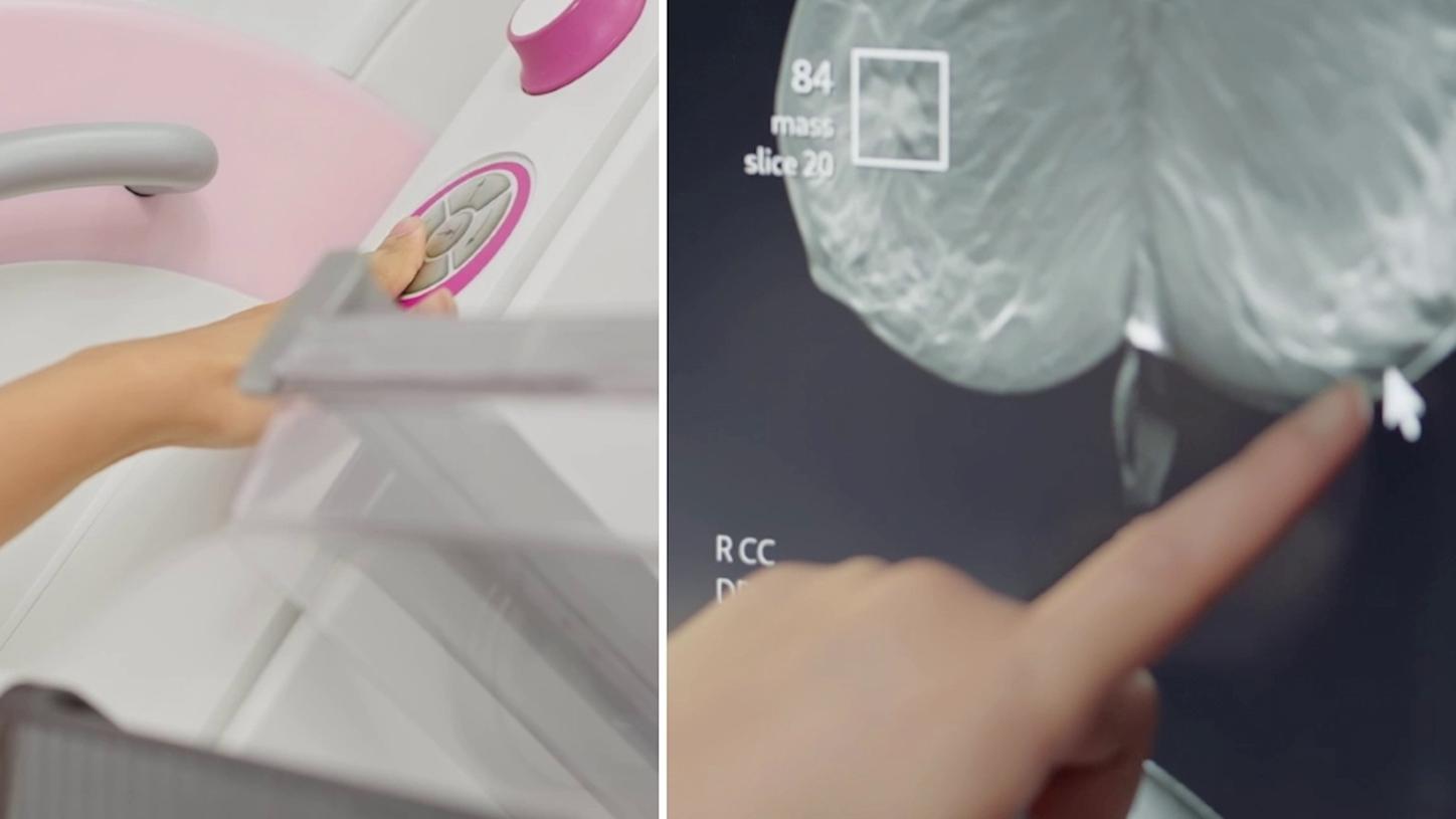 Fotokomposition der Nahaufnahme eines Mammographiesystems und des jeweiligen klinischen Bildes.