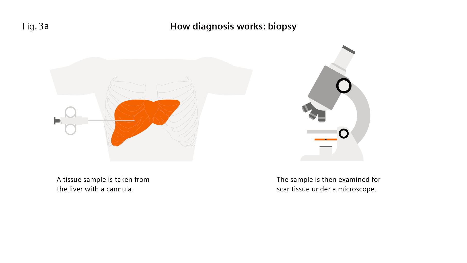 Liver fibrosis Patients can be at risk of death even without exhibiting symptoms
