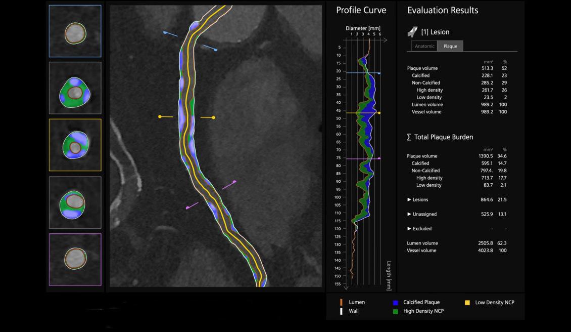To further enhance diagnostic confidence, Syngo.CT Coronary Cockpit characterizes both the amount and the morphology of coronary plaque through AI-based segmentation, labeling, and visualization. 