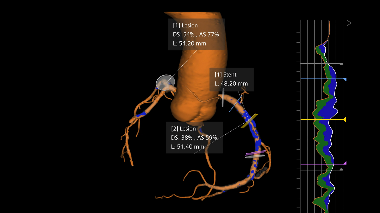 Detailed anatomical and morphological information support more precise plaque assessment and can inform key intraprocedural decisions, such as lesion preparation, stent length, and landing-zone selection.