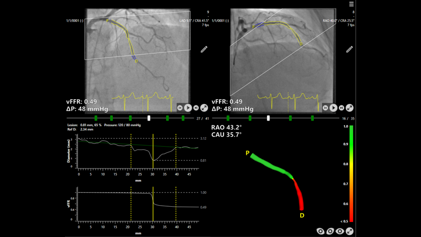 CAAS vFFR software by Pie Medical Imaging, as used in the FAST III study