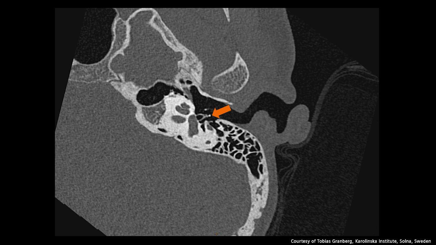 Photon-counting CT scan of the temporal bone