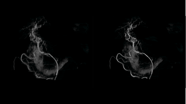 Syngo DynaCT MORE leverages iterative reconstructions for automatic motion correction to provide a realignment of high-contrast structures like vessels and devices like catheters. 