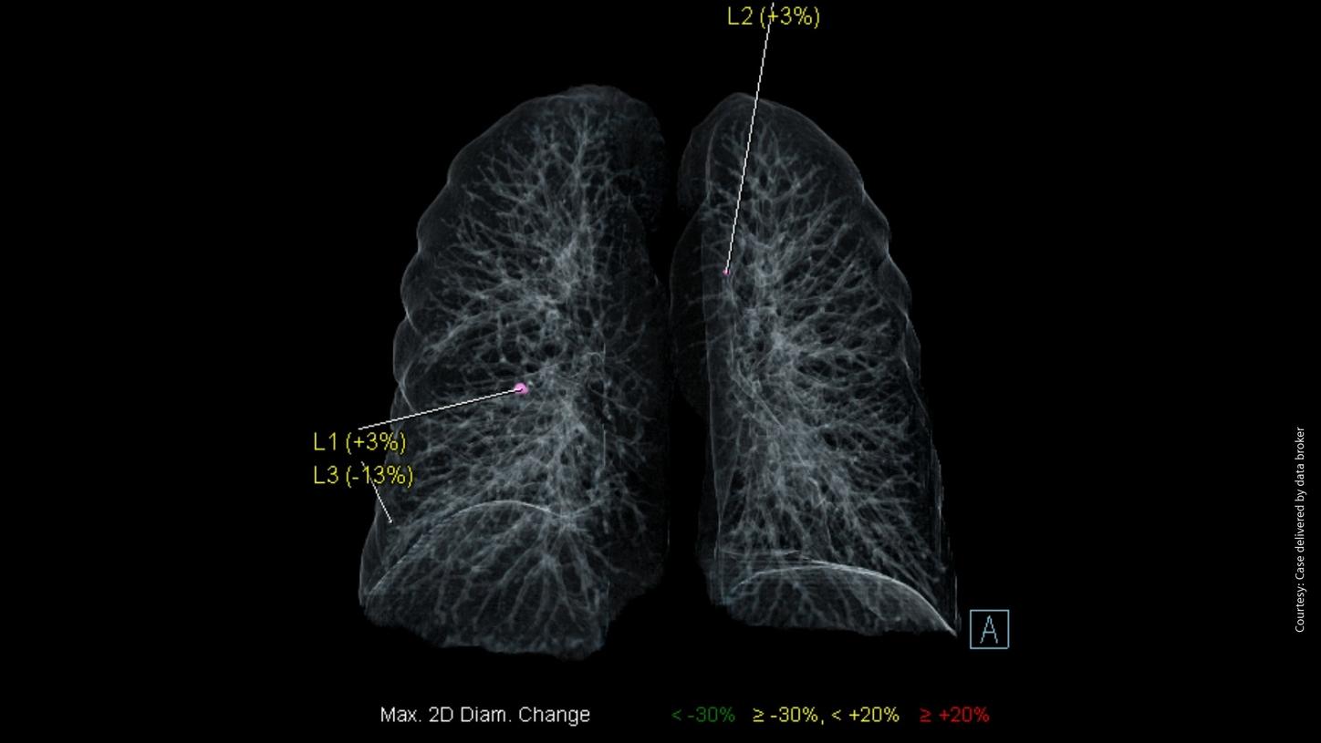 Clinical image of lung nodules detected with AI Rad Companion Chest CT.