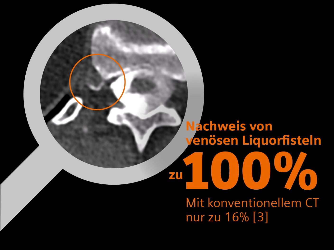 Infografik zeigt, dass 100% der venösen Liquorfisteln mit photonenzählender CT gefunden wurden.
