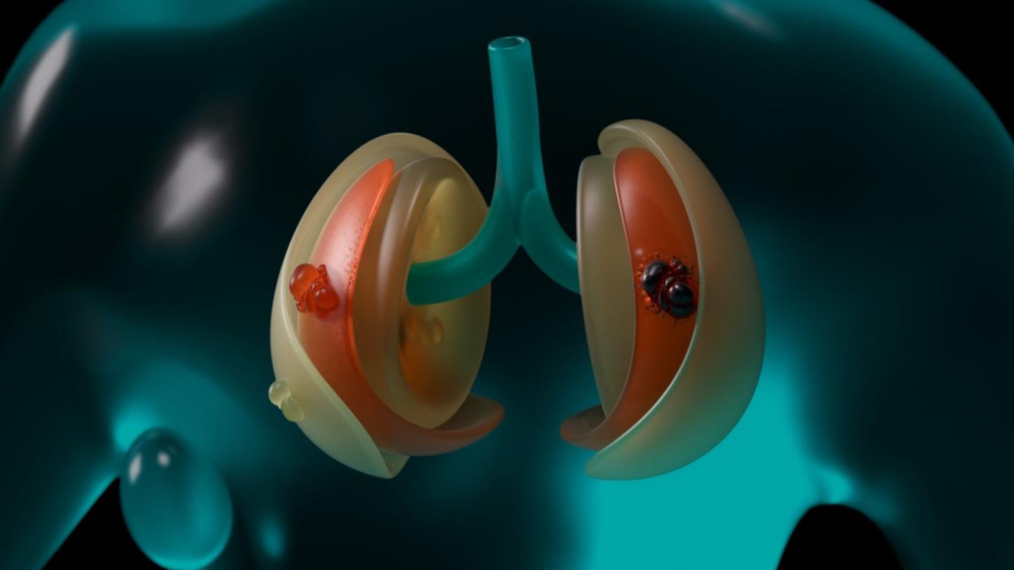 Still 3D rendering. In a semi-close-up shot, we see the abstractly depicted digital twin of the lungs within the fluid body. In the right lung, inactive tumors are shown as transparent vesicles. In the left lung you can see the digital twin of an active tumor, which is shown in black and red with fire glow.