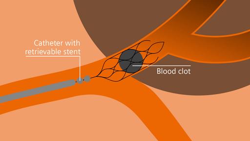 Tackling stroke with speed and precision