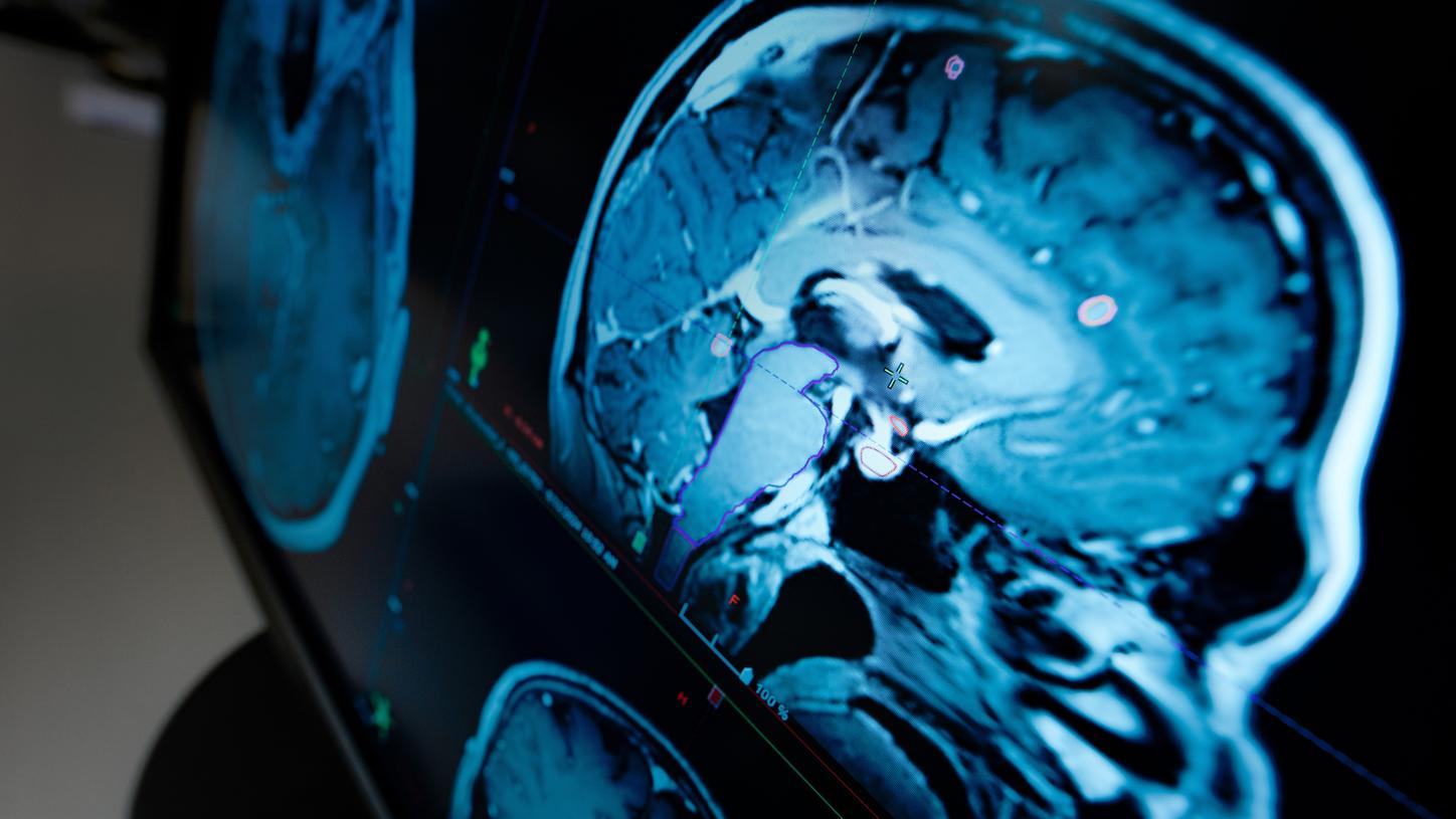 Close-up of a brain MRI scan displayed on a medical imaging screen, with highlighted regions and measurement markers visible.